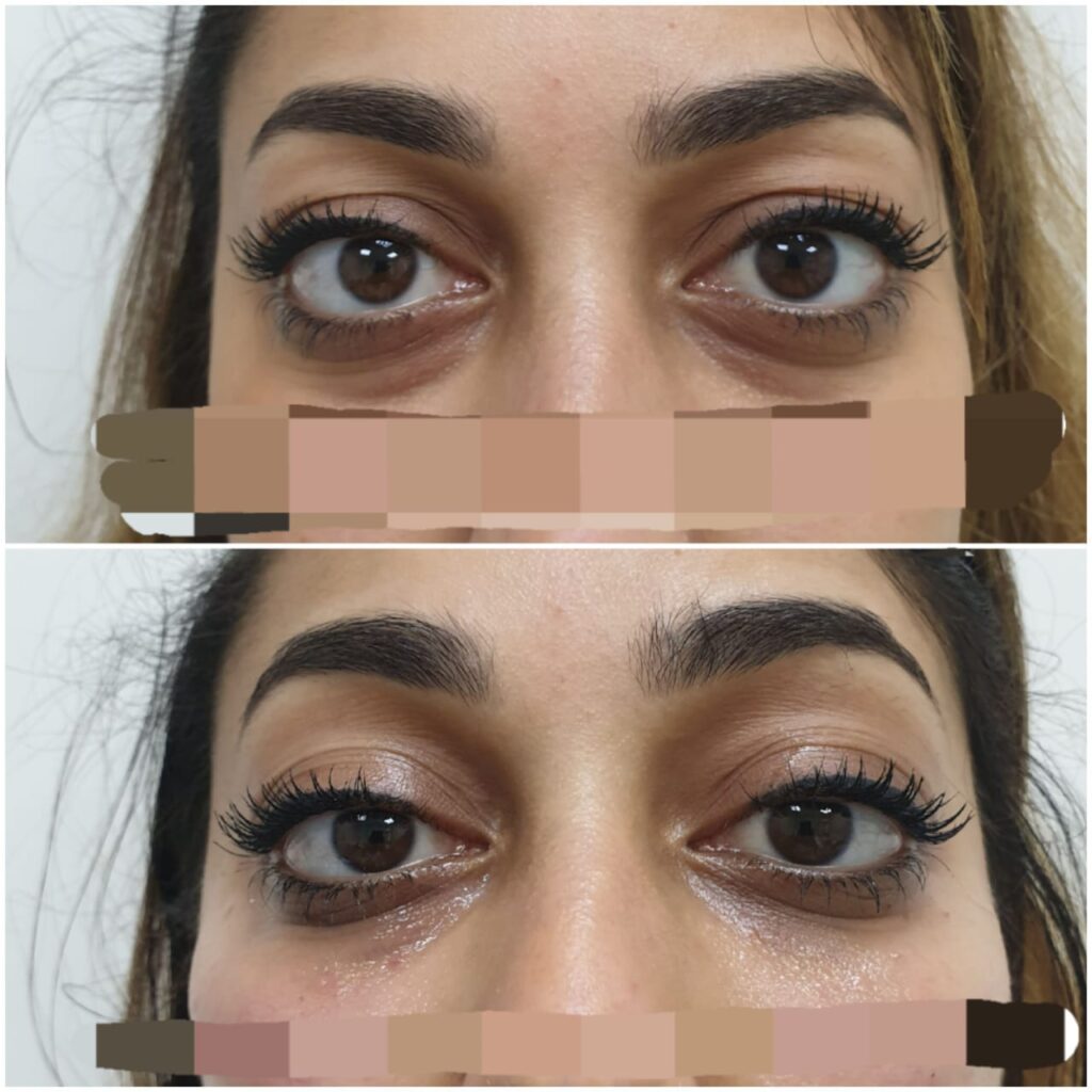 Botox Treatment Before And After