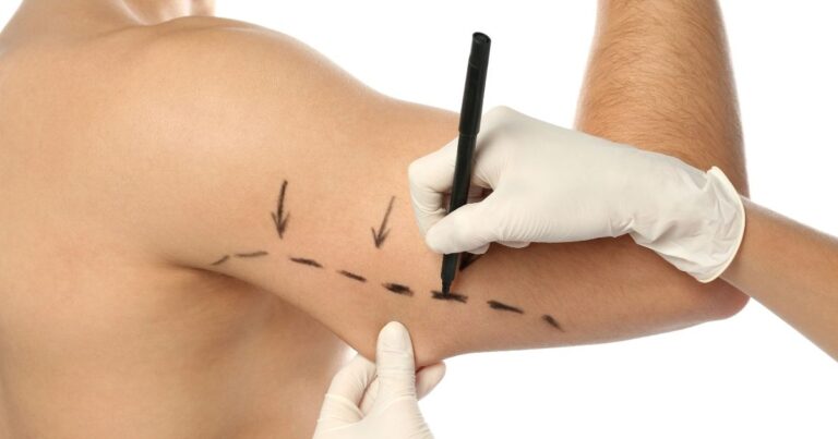 Arm Lift Surgery in Dubai - Arm Fat Reduction