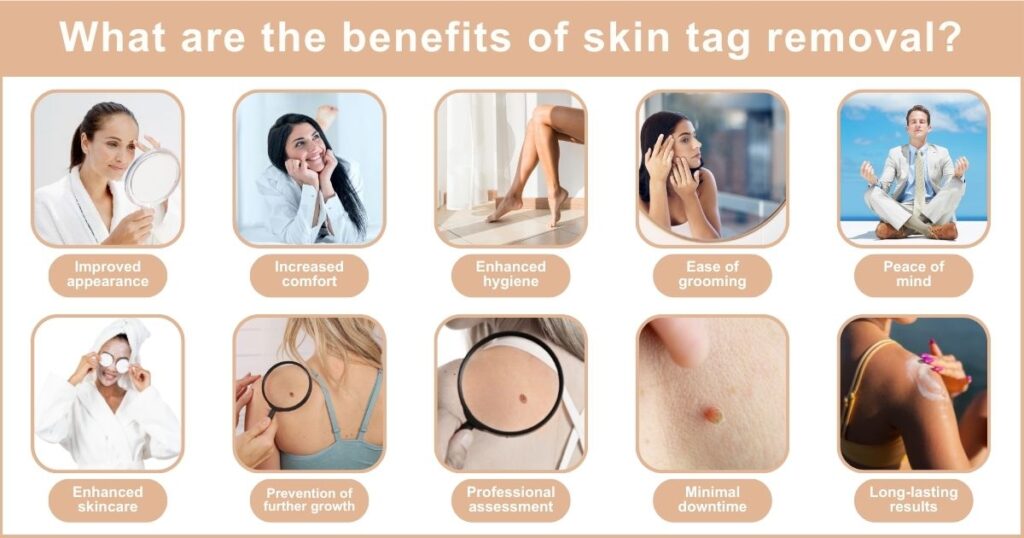 Best Skin Tag Removal in Dubai