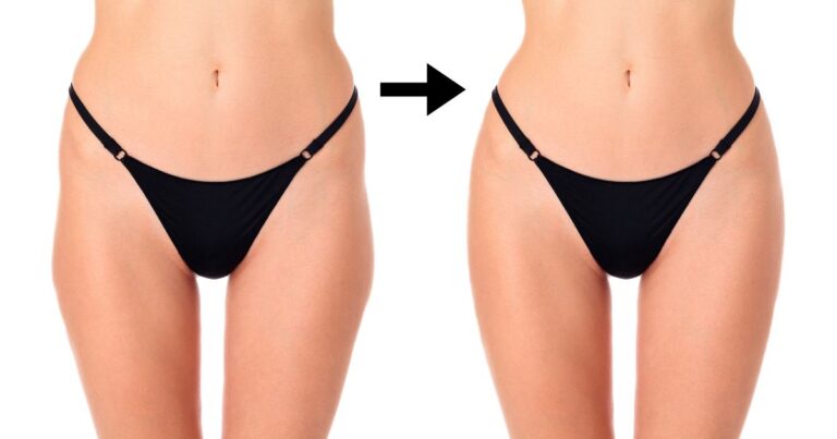 Best Vaser Liposuction in Dubai