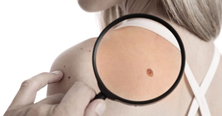 Cost of Skin Tag Removal in Dubai