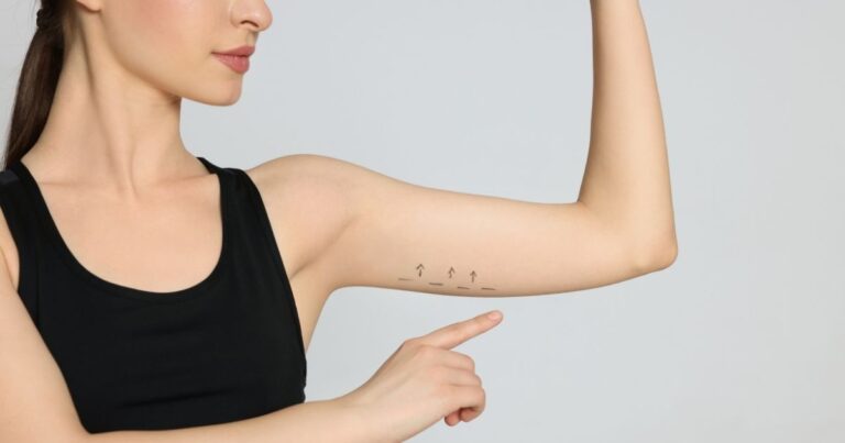 How to Get Rid of Flabby Arms with Liposuction