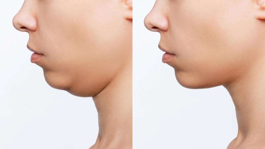 How to Get Rid of a Double Chin with Laser Liposuction 
