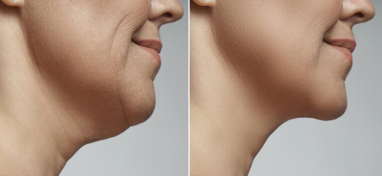 How to Get Rid of a Double Chin with Laser Liposuction