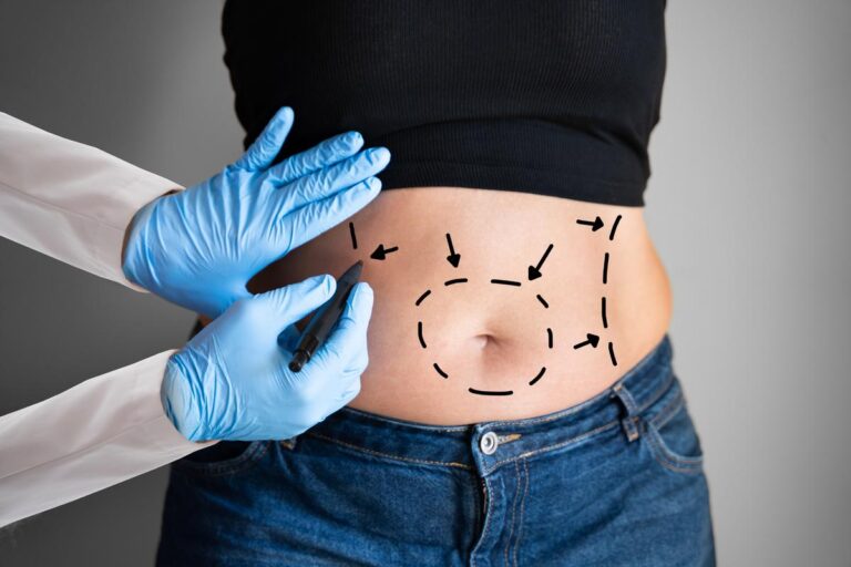 Liposuction Techniques Deciding the Right Technique for You