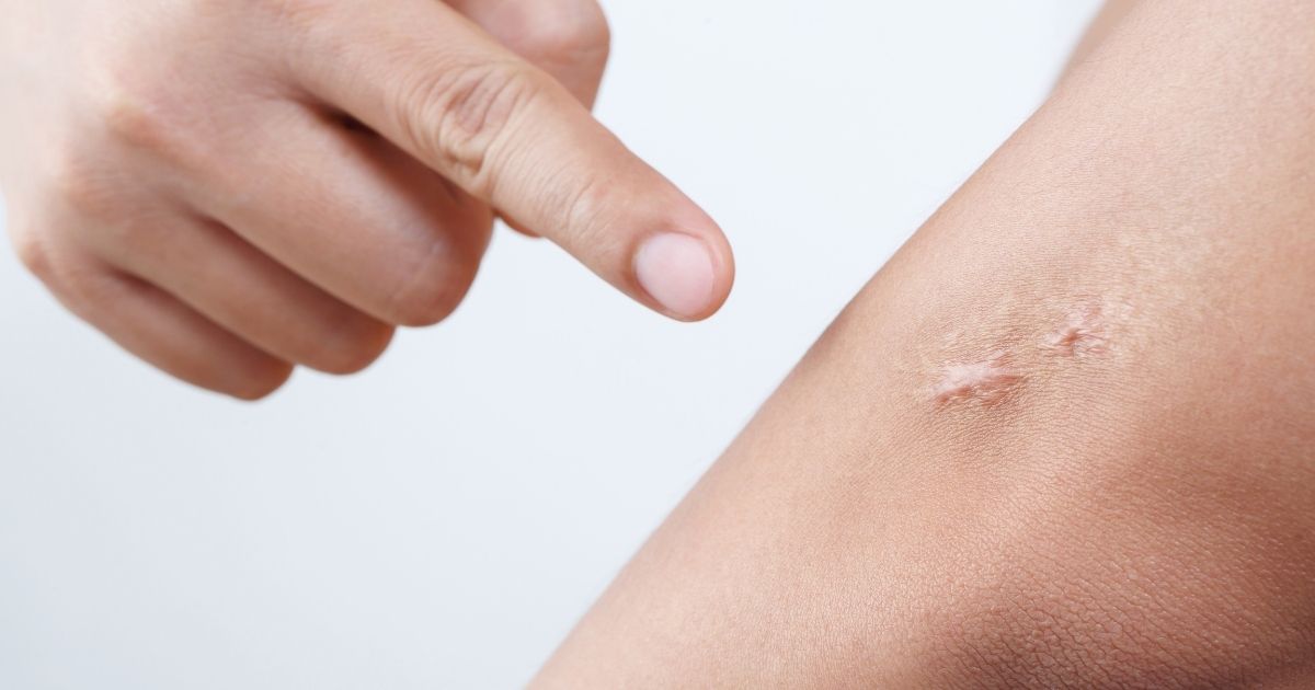 Everyday Cuts and Scrapes: How to Prevent Scarring | Johns Hopkins Medicine