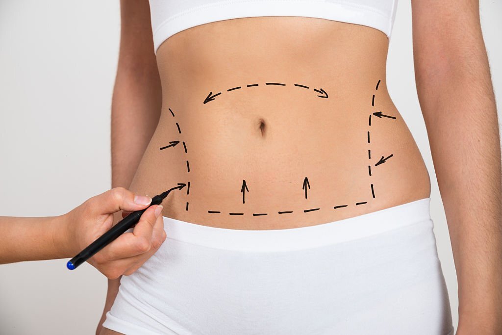 Risk Factors Associated with Liposuction