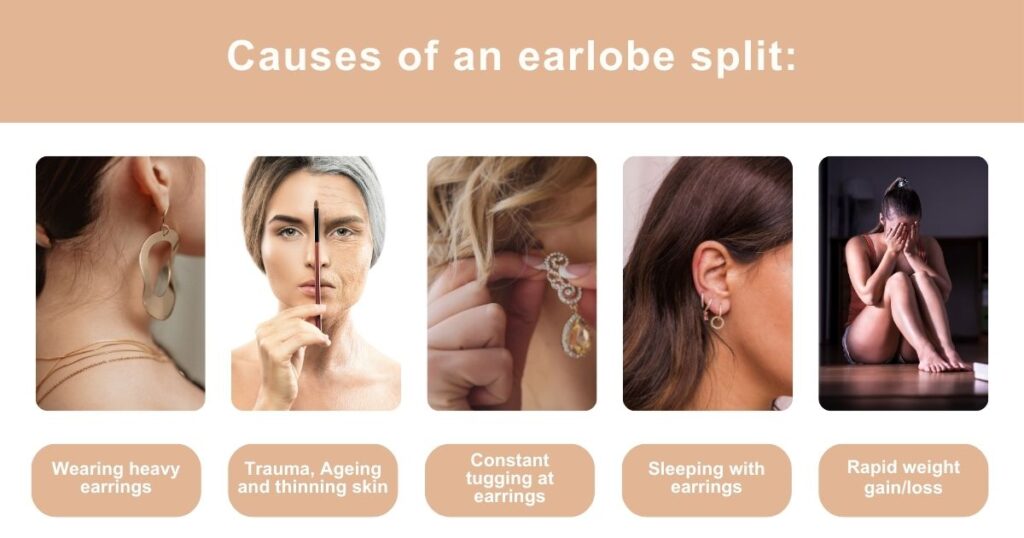 Earlobe Split from Earring