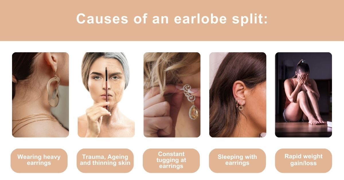 Earlobe Split From Earring By Dr Shehzadi Tasneem