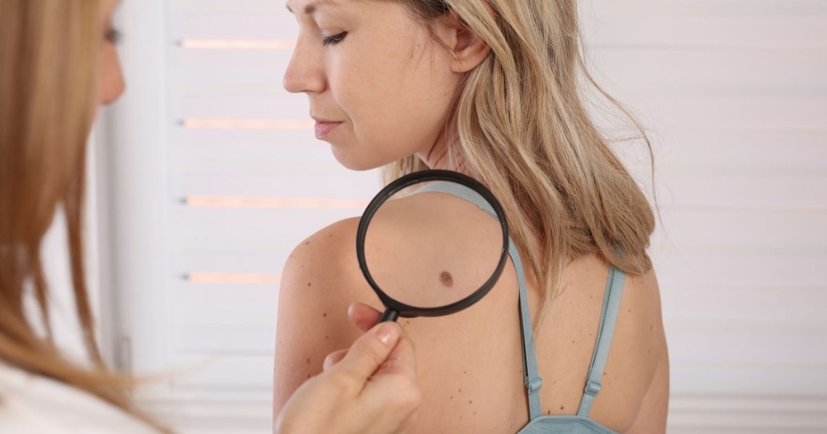 How to Choose the Right Specialist for Skin Tag Removal