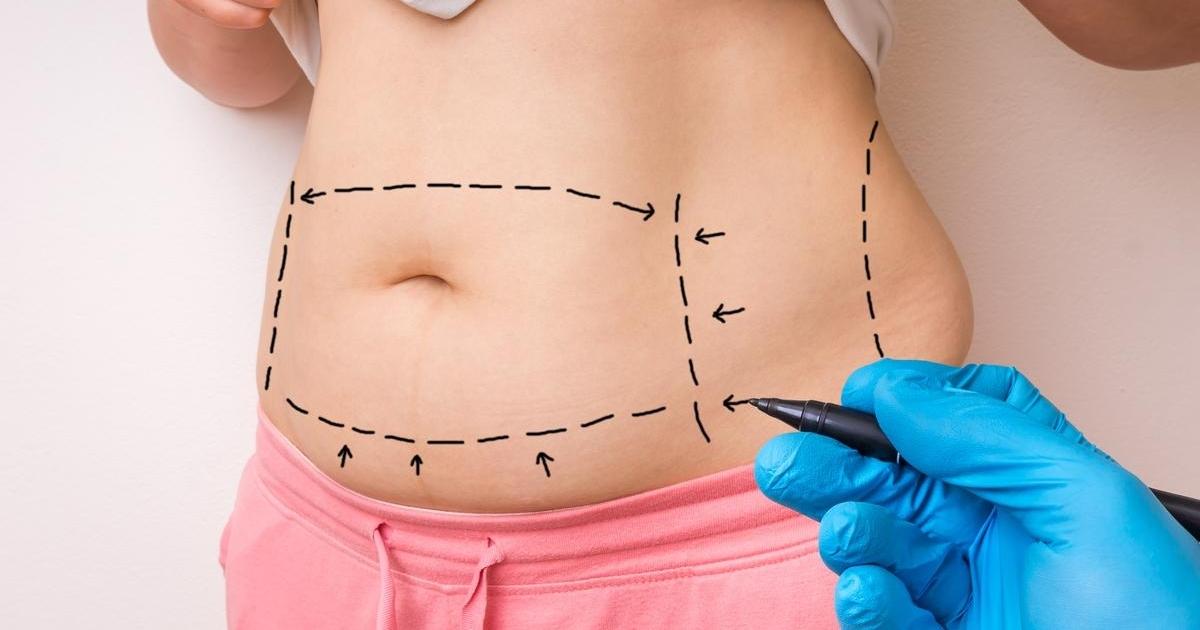Is a Partial Tummy Tuck Right for You