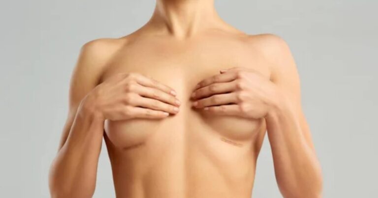 Managing And Minimising Scars After Breast Augmentation