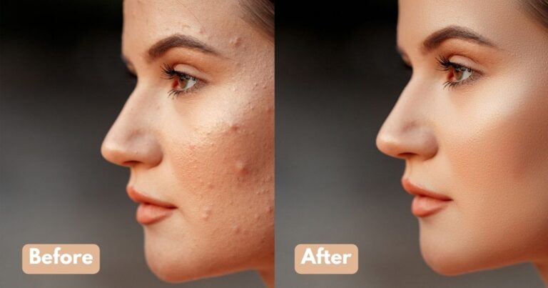 Skin Boosters Before and After Results: Your Guide to a Radiant Transformation