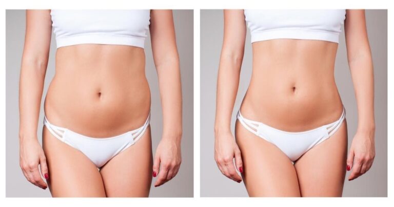 What to Expect After Liposuction in 1 Week