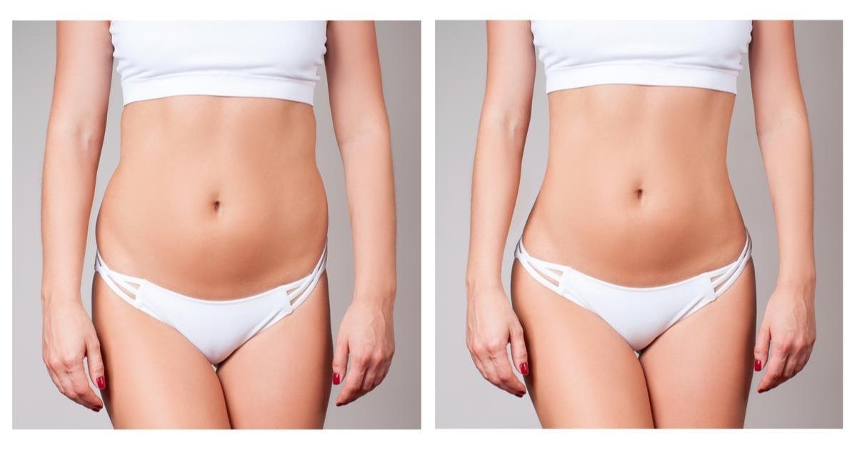 What to Expect After Liposuction in 1 Week