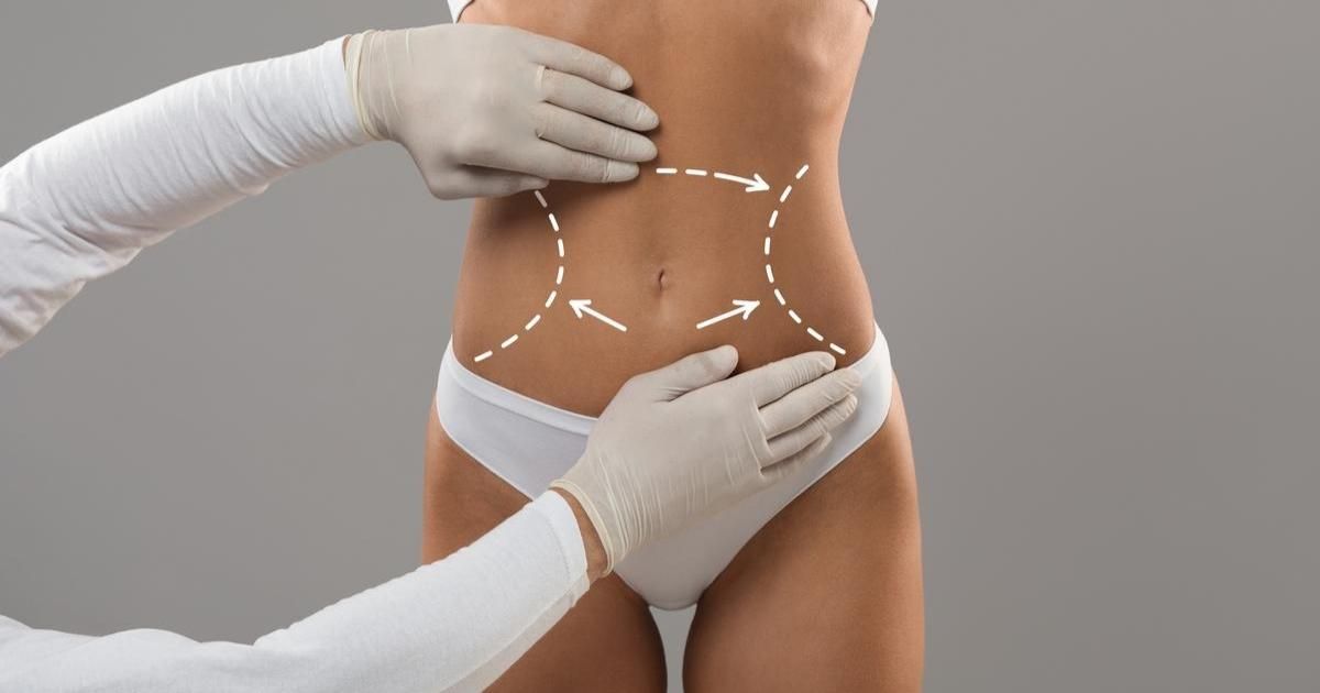 Complete Body Contouring with 360 Tummy Tuck