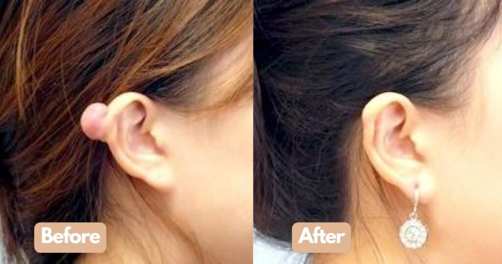 Keloid Scar Ear Surgery -before and after results