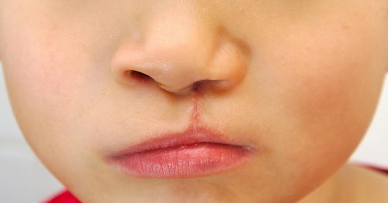 Keloid Scar Lip Treatment Options: Regain Your Smile
