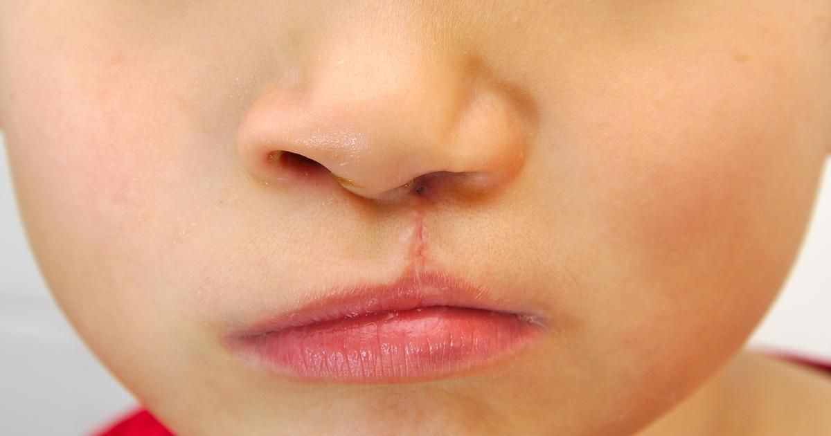 Keloid Scar Lip Treatment Options