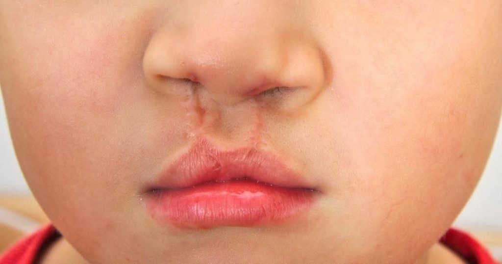 How to Identify a Keloid Scar on Your Lip