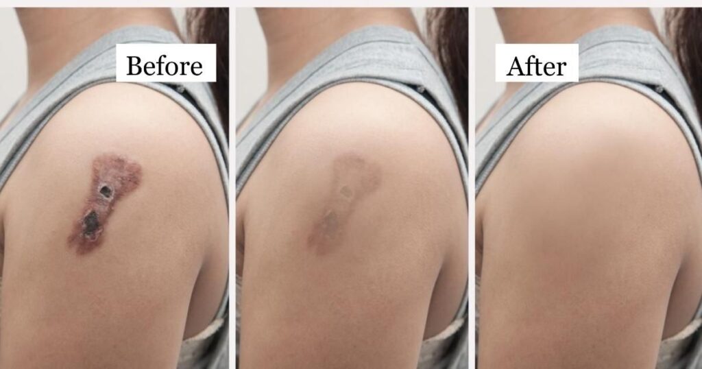 reasons why you need second chance for keloid scar surgery