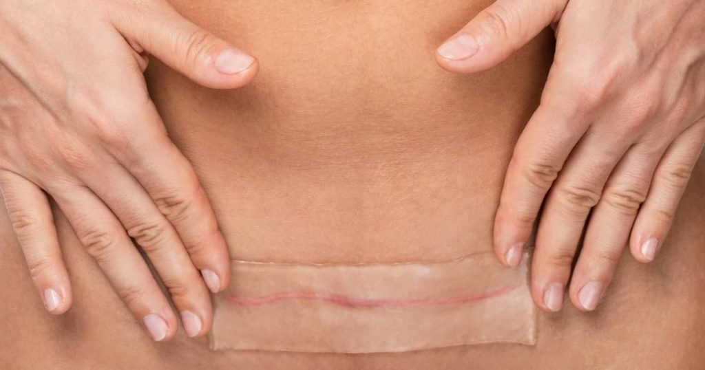 Scar-Revision-for-Tummy-Tuck