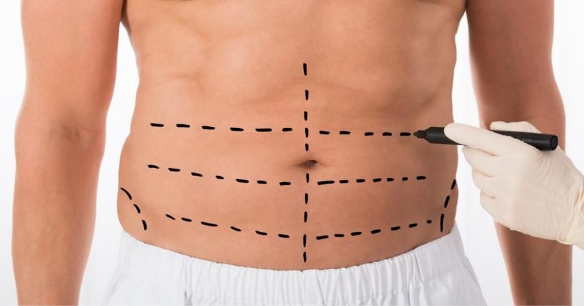 Tummy Tuck Surgery for Men_ What You Should Know