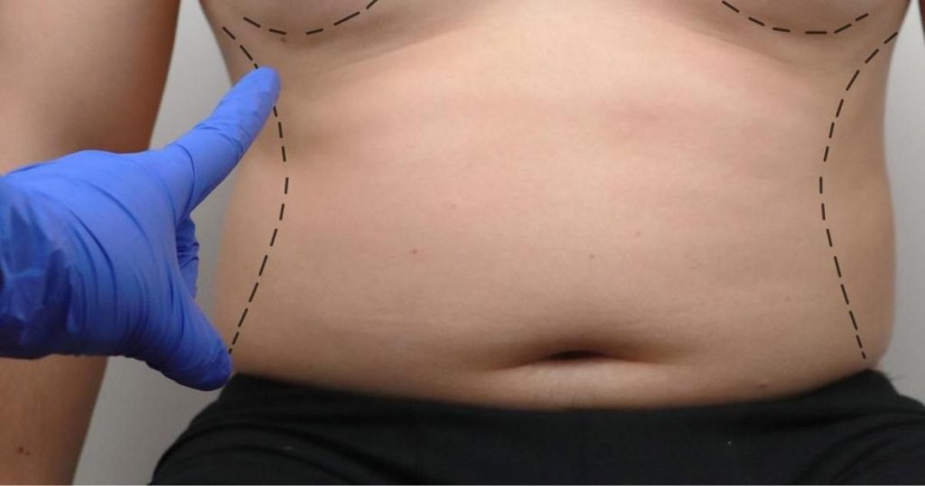 What Happens During a Male Tummy Tuck?