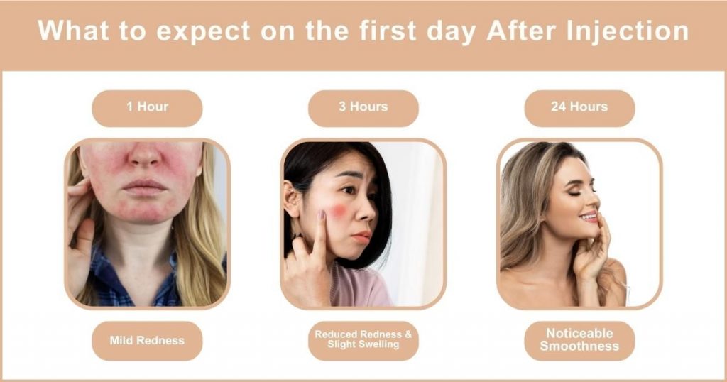 What to expect after day 1 botox