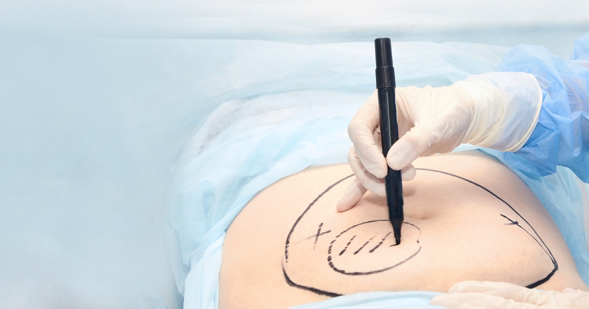 The Tummy Tuck Procedure_ What You Need to Know
