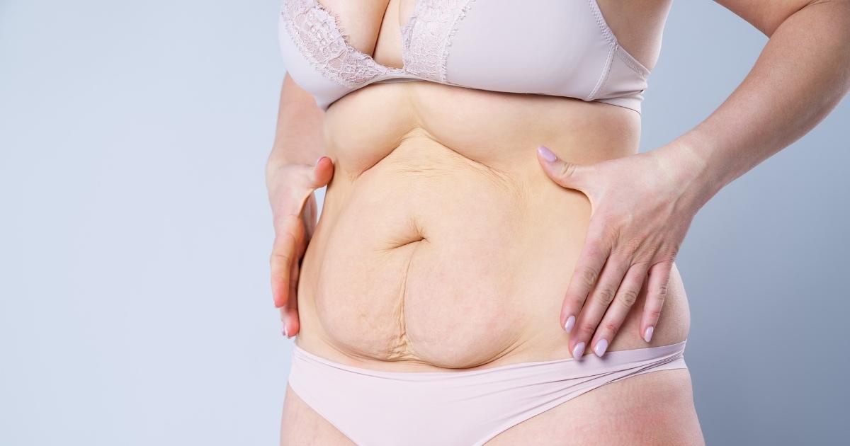 Tummy Tuck Scars: Healing, Treatment & Prevention