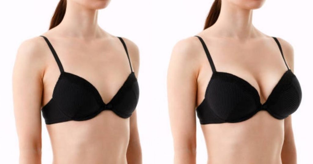 Before and After_ Real-life Results of Breast Uplift Without Implants