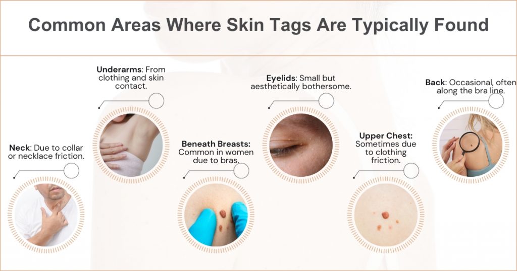 Common Areas Where Skin Tags Are Found