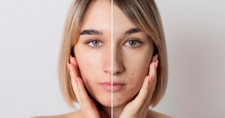 Facial Keloid Scar Removal: Restoring Your Natural Glow