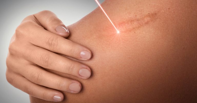 Laser Keloid Removal Near Me: Your Solution for Scar-Free Skin