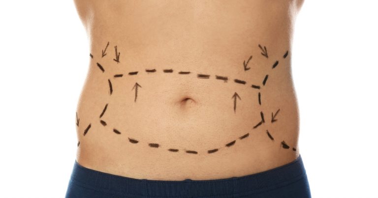 Mini Tummy Tuck: A Quick Guide