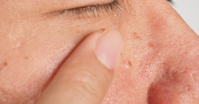 Removing Skin Tags Safely near the Eye Area