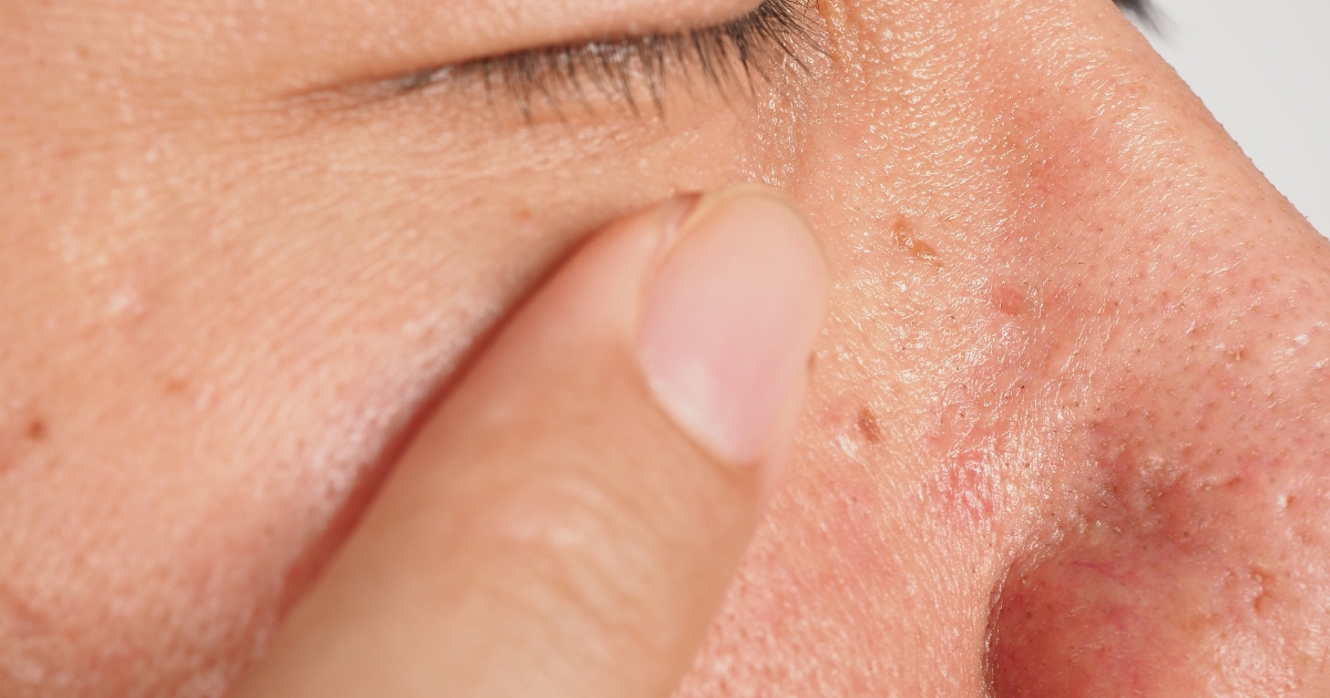 Removing Skin Tags Safely near the Eye Area