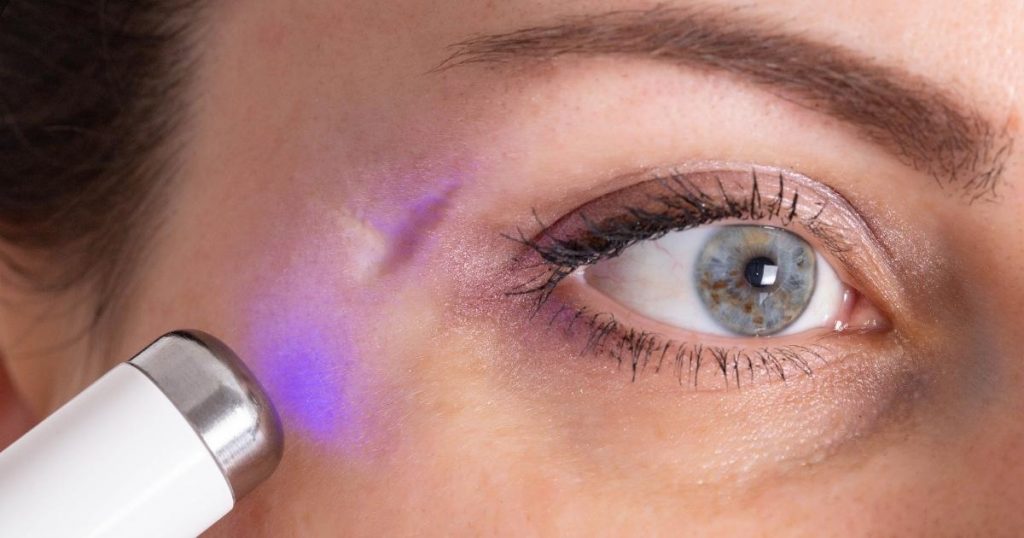 The Role of Laser Therapy in Facial Keloid Scar Removal
