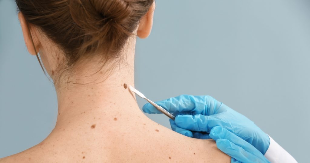 Traditional Surgical Excision of Skin Tags