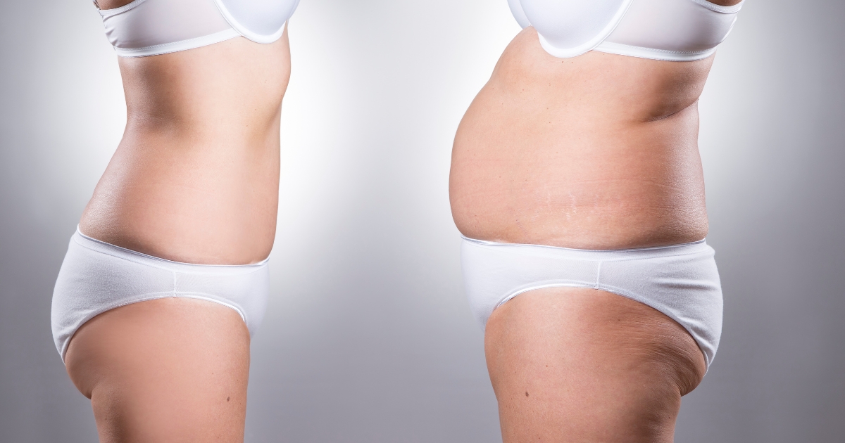 Tummy Tuck Before and After_ Transforming Your Midsection