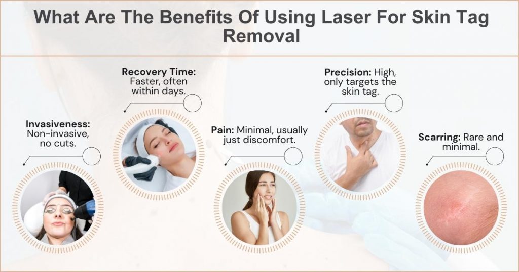 What Are The Benefits Of Using Laser For Skin Tag Removal 