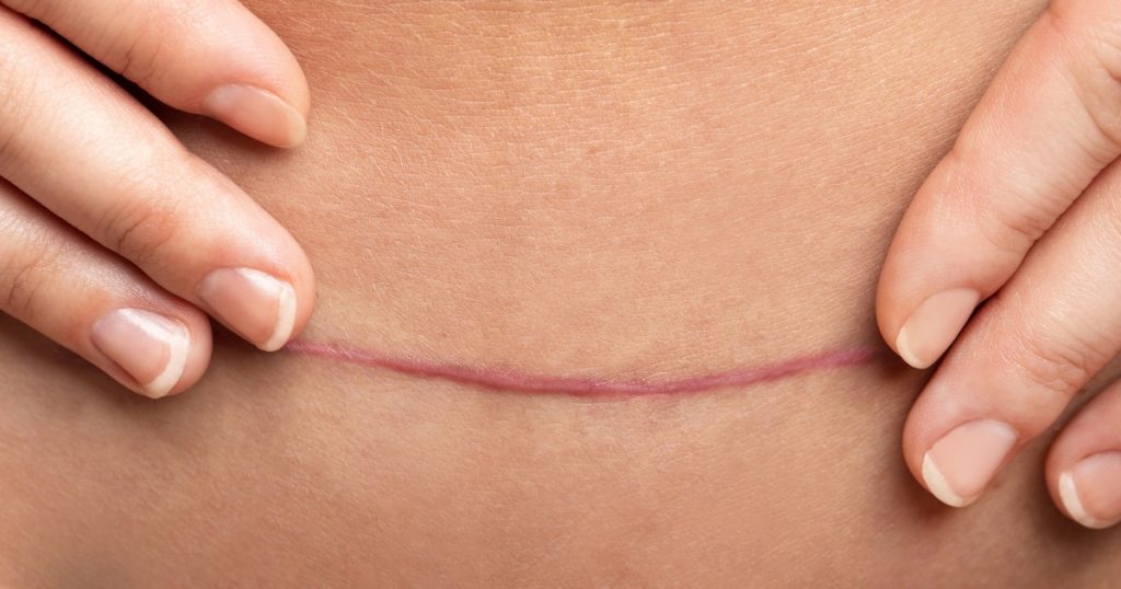 Can You Minimise Visible Scarring With Tummy Tuck Incisions