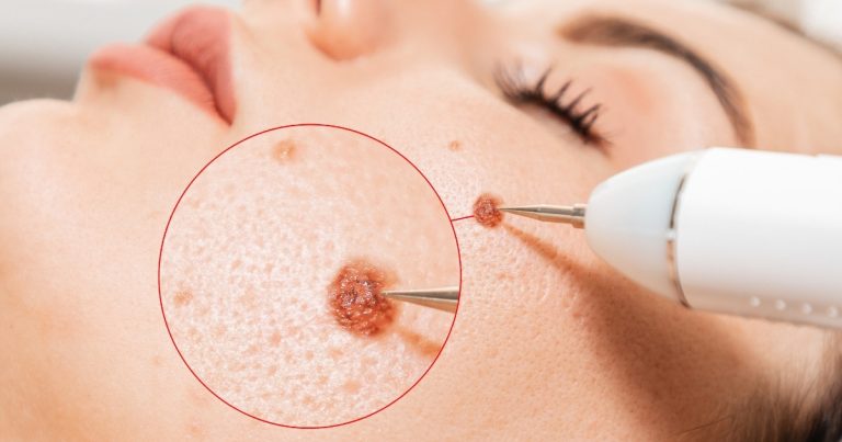 Cryotherapy Scar Removal: An Overview