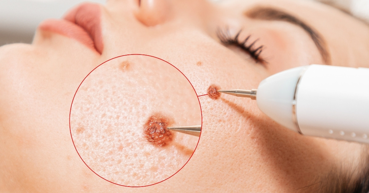 Cryotherapy Scar Removal_ An Overview