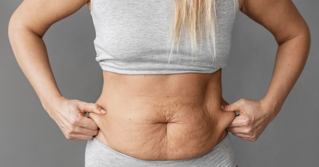 How long does swelling last after liposuction with tummy tuck