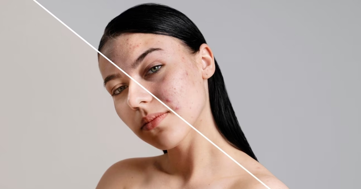 Is permanent skin tag removal possible or do they eventually regrow | 2024