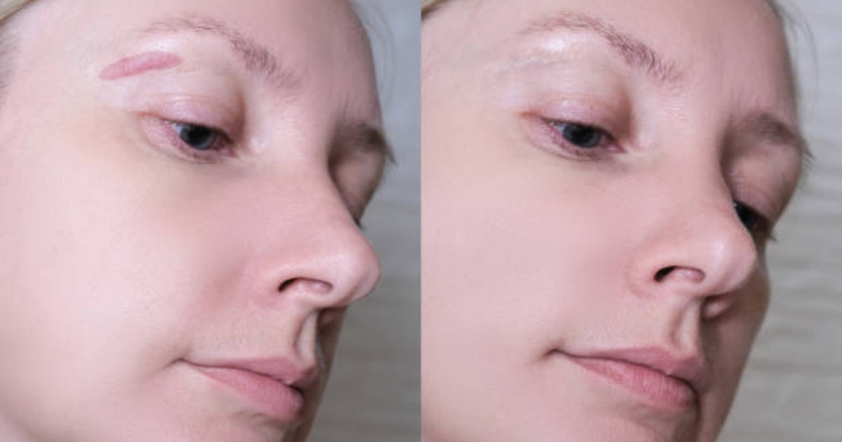 Keloid Scar Removal On Face
