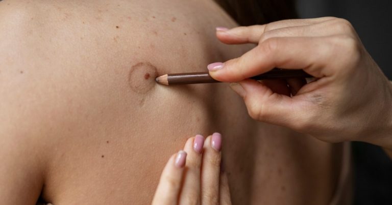 Skin Tag Removal: Does it Hurt?
