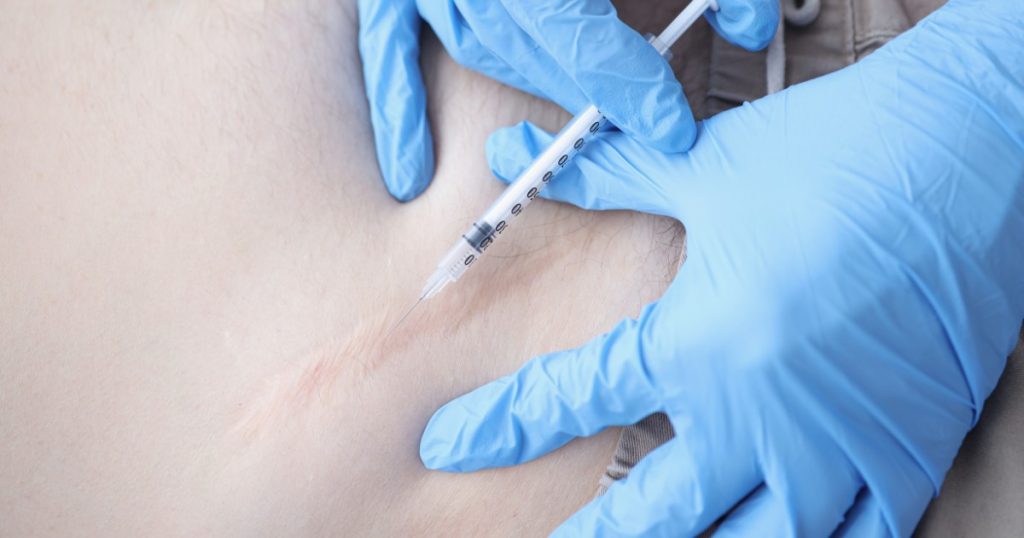 Steroid injections prevent keloids from getting more significant